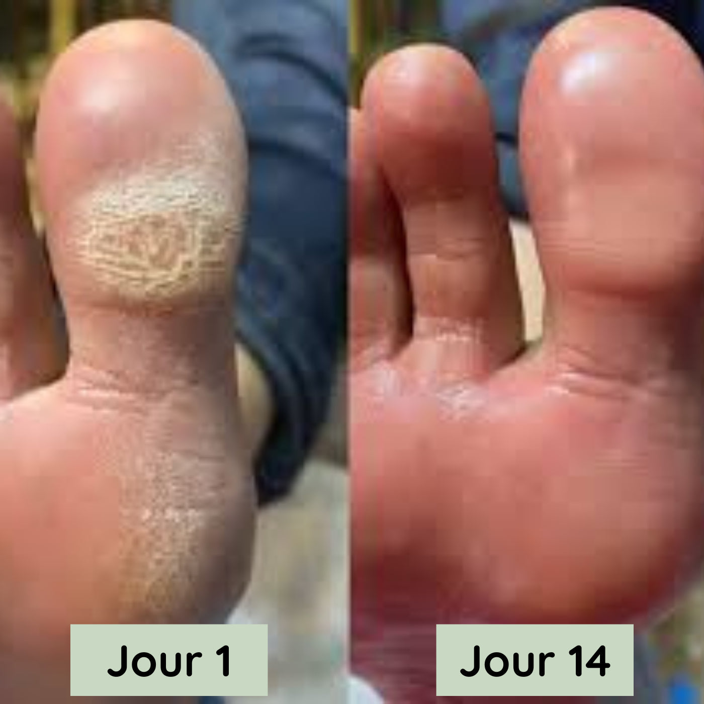 Résultat après 14 jours — Laurent T.
